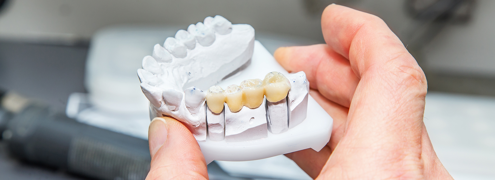 The image shows a person holding a dental model with missing teeth, possibly in the context of a dental office or during a dental education session.