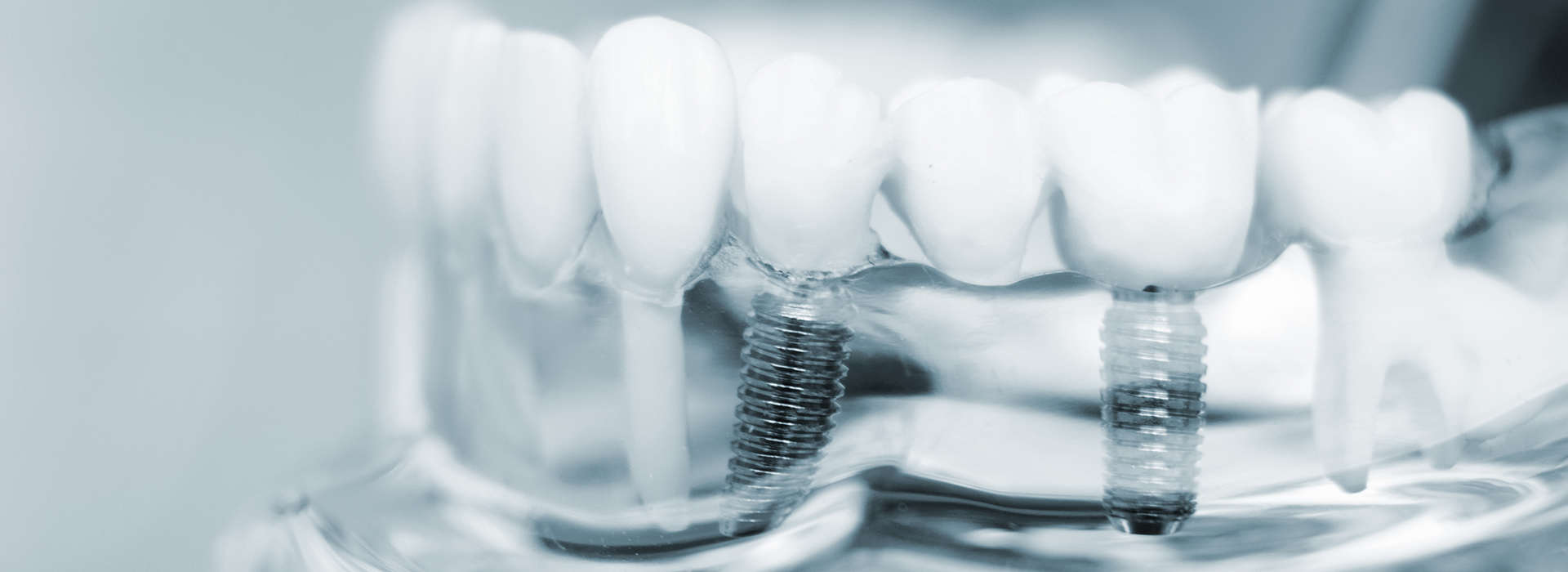 An image of a close-up dental implant with screws and abutments, showcasing the process of dental restoration.