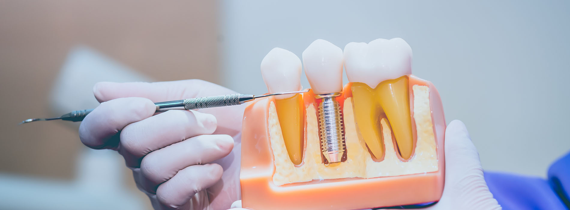 An image showcasing a dental device with visible screws, held by a person s hand, set against a blurred background.